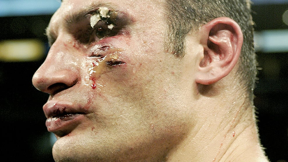 10 of the worst cuts in boxing history